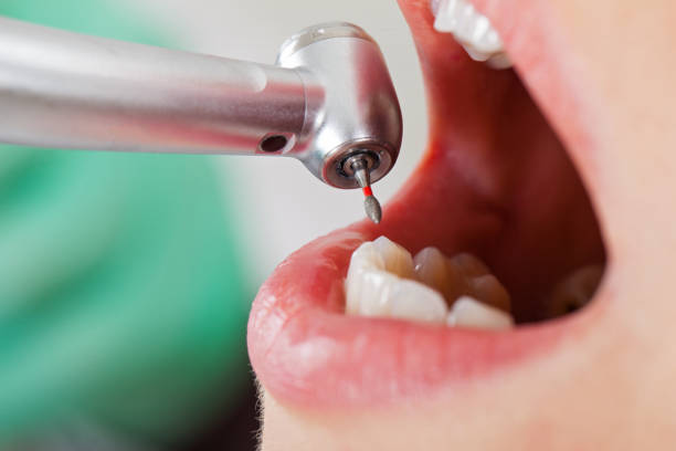 Best Emergency Dentist for Knocked-Out Tooth in Reminderville, OH